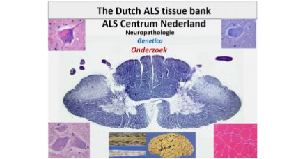 ALS Centrum Nederland genetica onderzoek